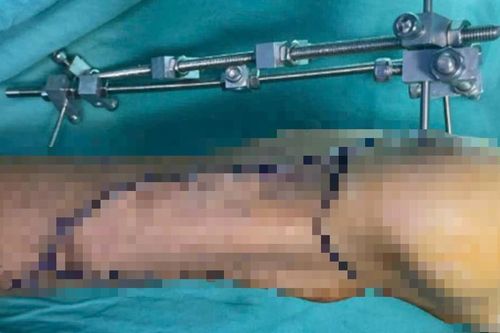 20 năm đi kiễng vì gót chân không chạm đất, chàng trai được phẫu thuật thành công