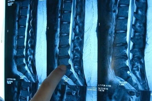 Nữ sinh 13 tuổi nhưng cột sống hỏng nặng như người già