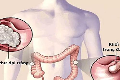 Ung thư đại trực tràng thường di căn đến đâu?