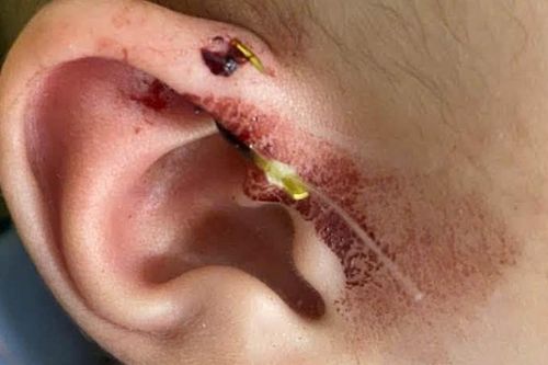 Lưỡi câu móc vào vành tai bé 10 tháng tuổi