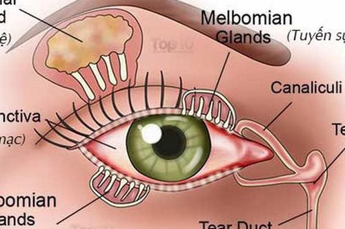 Tại sao người cao tuổi dễ bị khô mắt và cách khắc phục