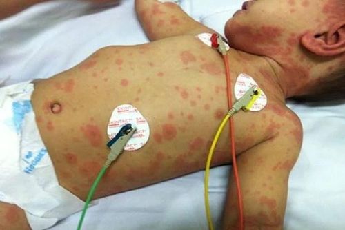 Bệnh có thể gây tử vong trong 24 giờ:Cảnh báo não mô cầu đầu năm học