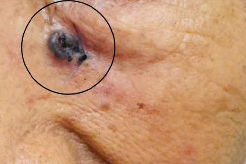 Người phụ nữ 69 tuổi tưởng vết trầy xước trên mặt, đi khám bất ngờ phát hiện ung thư da