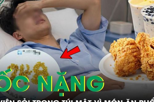 248 viên sỏi trong túi mật nam thanh niên 26 tuổi