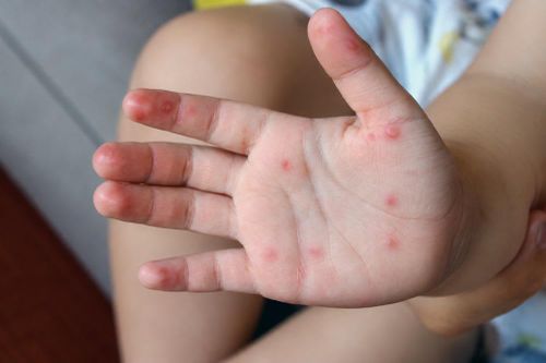 Bệnh tay chân miệng tăng khi trẻ trở lại trường