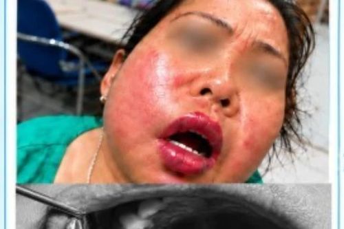 Điều trị tủy răng, người bệnh đái tháo đường nhiễm trùng không há được miệng