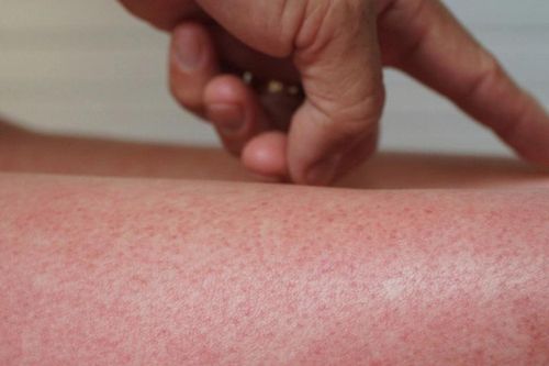 Hà Nội thêm hơn 200 ca sốt xuất huyết, cảnh báo nguy cơ tăng