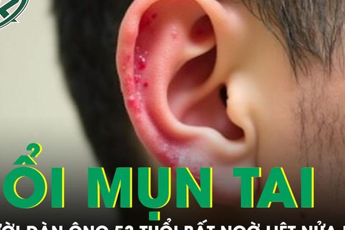 Nổi mụn nước ở tai, người đàn ông 53 tuổi bất ngờ liệt nửa mặt