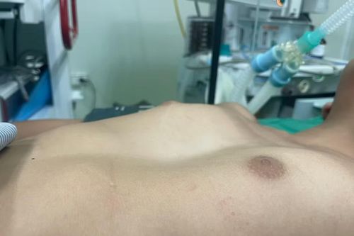 Lõm ngực bẩm sinh ở trẻ: Đừng bỏ qua dấu hiệu sớm
