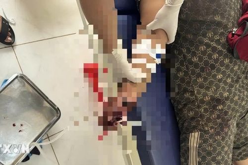 Lâm Đồng: Điện thoại phát nổ khi đang sạc, thiếu niên 16 tuổi bị thương nặng