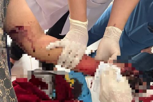 Điện thoại phát nổ khi đang sạc, thiếu niên 16 tuổi bị nát bàn tay
