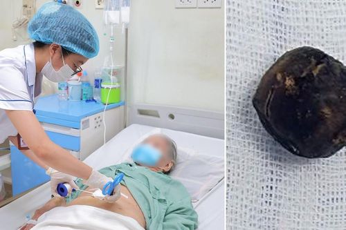 Chỉ uống men vi sinh vì tưởng đau bụng, cụ bà 90 tuổi phát hiện sỏi mật 25 mm mắc kẹt trong ruột