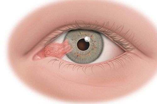 7 dấu hiệu nhận biết xước, rách giác mạc