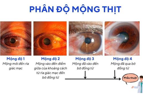 Mộng thịt khi nào cần phẫu thuật?