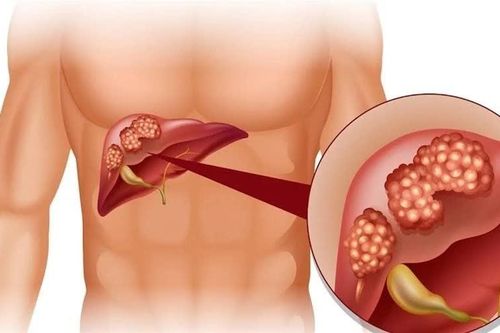 Khuyến cáo tổn thương gan cấp do sử dụng thuốc đông y không rõ nguồn gốc