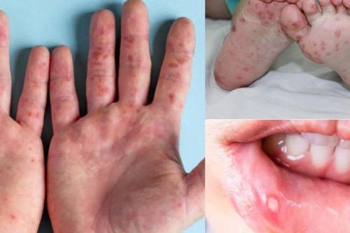 Sốt xuất huyết, tay chân miệng diễn biến phức tạp, Lâm Đồng khẩn cấp phòng dịch