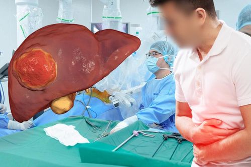 Ngỡ rối loạn tiêu hóa, người đàn ông bất ngờ phát hiện ung thư gan