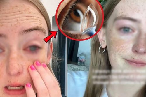 Đeo kính áp tròng khi tắm, cô gái 20 tuổi suýt mù mắt