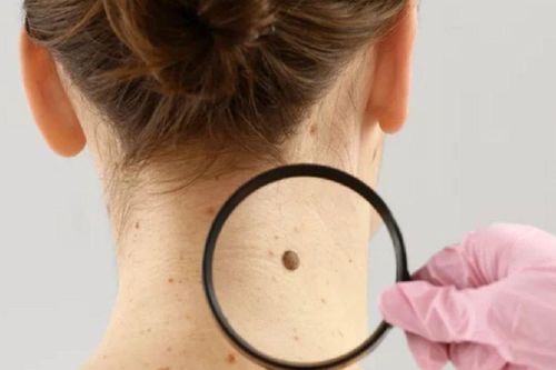 Những dấu hiệu cảnh báo ung thư da, nhiều người chủ quan thường hay bỏ qua