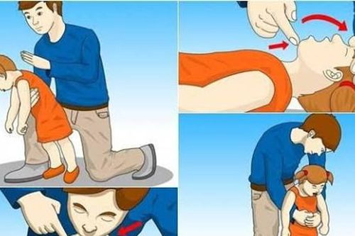 Dấu hiệu nhận biết trẻ bị hóc dị vật