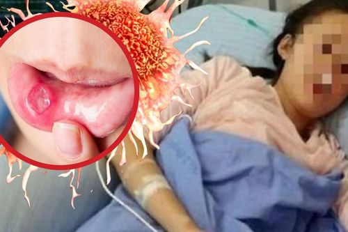Cô gái 26 tuổi 'chết lặng' phát hiện ung thư giai đoạn 3 khi khám nhiệt miệng