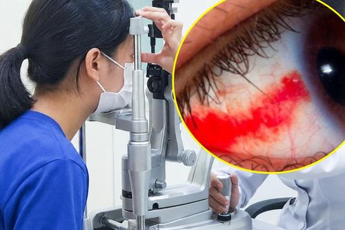 Bé gái 12 tuổi bị dây cáp quẹt vào mắt rách võng mạc