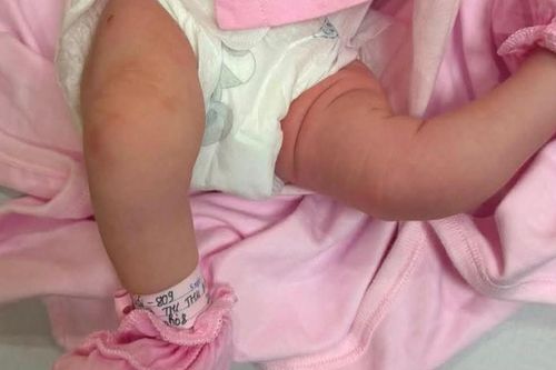 Bệnh viện Nhi Hải Phòng phẫu thuật thành công bé sơ sinh chân 'gập ngược' bất thường