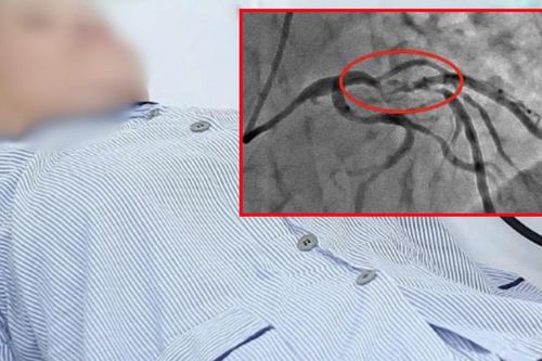 Đau vùng thượng vị, người phụ nữ bất ngờ phát hiện nhồi máu cơ tim nguy hiểm