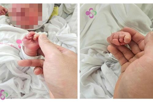 Phẫu thuật cứu cẳng chân bé sơ sinh 12 giờ tuổi bị dải sợi ối thắt nghẹt