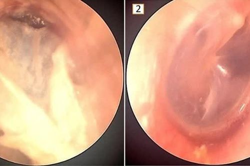 Coi chừng 'rước' nấm vào tai khi thường xuyên ngoáy tai, lấy ráy tai ở tiệm