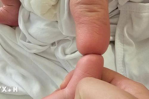 Phẫu thuật thành công cho trẻ sơ sinh bị vòng xơ thắt nghẹt chi