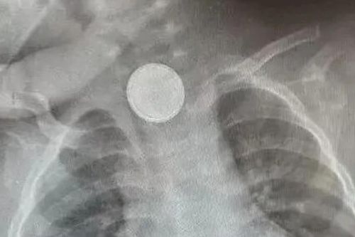 Bé gái hơn 1 tuổi cứ ăn là nôn, bố mẹ sốc khi biết sự thật