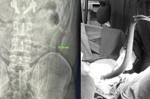 Nhét lươn sống dài nửa mét vào hậu môn, người đàn ông suýt thủng ruột