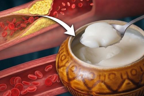 Người tăng huyết áp và rối loạn mỡ máu có nên ăn mỡ lợn không?