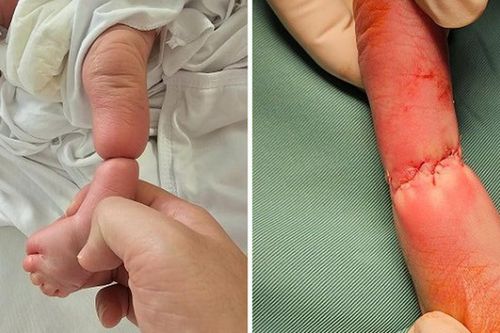 Giải cứu chi cho bé sơ sinh mắc hội chứng dải sợi ối hiếm gặp