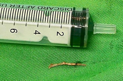 Mắc xương cá, người đàn ông phải cắt bỏ tuyến dưới hàm