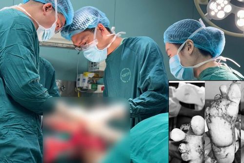 Suýt mất 2 bàn chân vì tự chườm nóng tại nhà khi bị tê bì