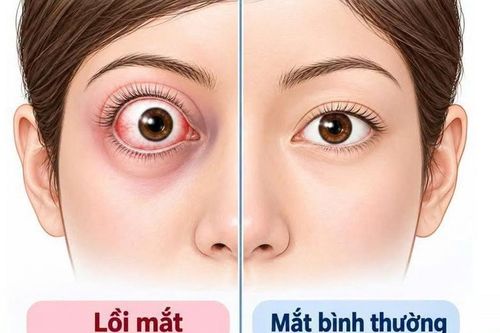Mắt lồi, mất thị lực do khối u nằm sâu sau nhãn cầu