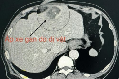 Bệnh nhân ở TP.HCM rơi vào bạo bệnh chỉ vì miếng xương cá
