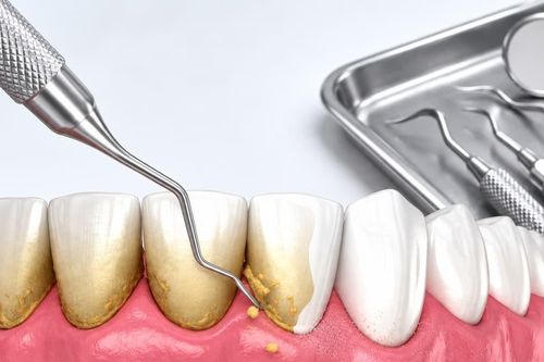 Lấy cao răng có được bảo hiểm y tế chi trả không?