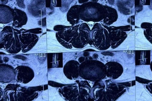 Đau lưng, tê chân kéo dài, người phụ nữ 52 tuổi phát hiện rễ thần kinh bị chèn ép