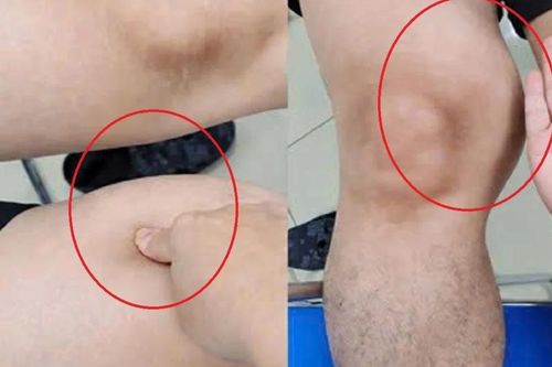 Đùi to bất thường suốt một năm, người đàn ông phát hiện ung thư hiếm gặp