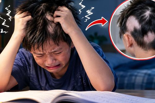 Ôn thi căng thẳng, bé trai tự nhổ tóc đến trơ từng mảng da đầu