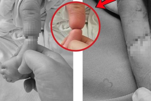 Mắc dị tật hiếm 1/15.000 ca, bé sơ sinh bị 'sợi dây ẩn' thắt nghẹt