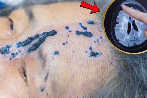 Đắp lá chữa bóng nước, cụ bà suýt mù mắt vì biến chứng zona thần kinh