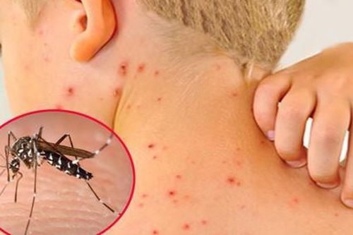 7 dấu hiệu cảnh báo sốt xuất huyết chuyển nặng sau khi hết sốt