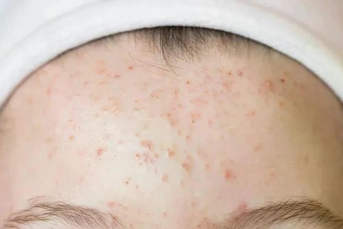 Thủ phạm gây ra mụn trên trán và cách ngăn chặn chúng hiệu quả