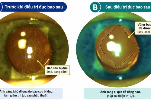 Đục bao sau: nguyên nhân giảm thị lực thường gặp sau mổ đục thể thủy tinh