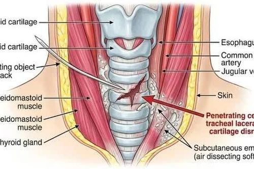 Chạy đua từng phút cứu chàng trai đứt rách nhiều vòng khí quản