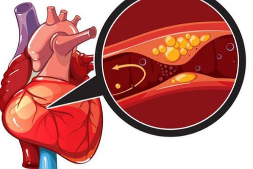 Đau ngực khi đá bóng, người đàn ông 32 tuổi phát hiện nhồi máu cơ tim